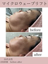 サロンドココ(Salon de COCO)/マイクロウェーブリフト