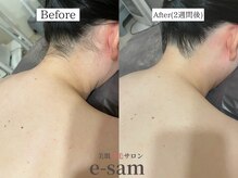 イーサム 高槻摂津富田店(e-sam)/丸ごと全身脱毛