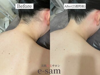 イーサム 高槻摂津富田店(e-sam)/丸ごと全身脱毛