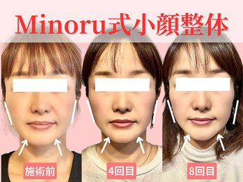 フレキシボディ(FlexiBody)/小顔施術ビフォーアフター #11