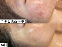 ビジュープラス 広島店(Bijou+)の雰囲気（有名インフルエンサーもREVIハーブピーリングで美肌ケア♪）