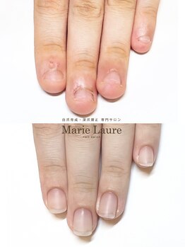 マリーロール 梅田店(Marie Laure)/自爪育成/深爪矯正/ネイルケア