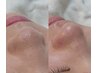【毛穴の黒ずみ・開きを解消でツヤ美肌に☆】 毛穴エクストラクションコース