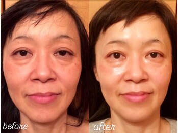 リフレッシュサロン シュクレ(Sucre)/老け顔たるみ改善!