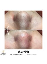 アクシア ビューティー サロン(AXSIA)/【毛穴洗浄】BeforeAfter