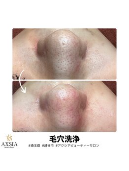 アクシア ビューティー サロン(AXSIA)/【毛穴洗浄】BeforeAfter