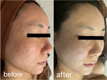 リヴェイラ(RIVEIRA)/グリーンピール5days