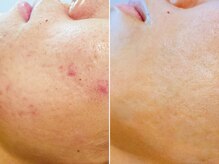 ハダイ(HADAY)/ニキビ改善｜ハーブピーリング