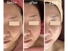 【小顔/リフトアップ】インディバフェイシャル♪立体的な美人顔15000→11,000