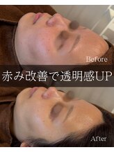 サロンドポノ(Salon de Pono)/毛穴集中コース