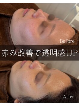 サロンドポノ(Salon de Pono)/毛穴集中コース