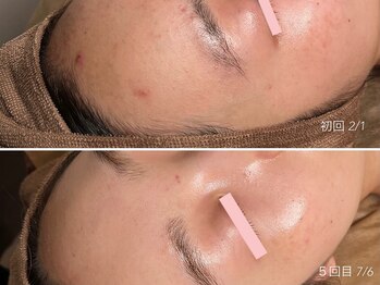 エイプリルフールズ(April fools)/【20代】繰り返す生え際のニキビ