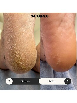 マオヌー(MAONU)/韓国式足裏角質ケア　症例写真