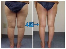 キャビテーション痩身メニューも豊富！