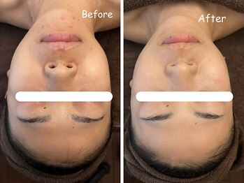 レイ(REI)/◆ニキビケア+毛穴ケア◆