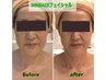 【人気NO.1★ウィンバックフェイシャル】リフトアップ・シミ・しわ・くすみ◎