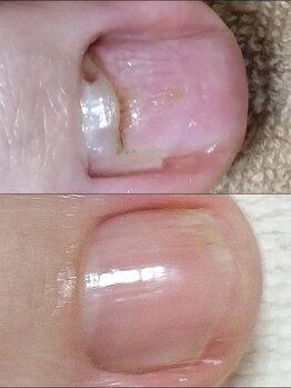 フットファースト 浜松天竜川店の写真/【爪のプロにお任せ♪】ドイツ式本格フットケアで爪/足のお悩みをトータルに解消できる専門サロン♪