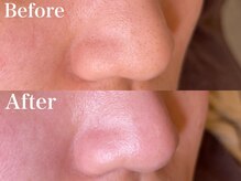 フォルトゥーナ(fortuna)/ハイドロスプラッシュ~毛穴洗浄~