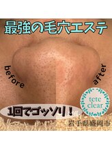 アモル(amor)/毛穴エクストラクション