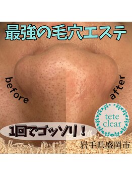 アモル(amor)/毛穴エクストラクション