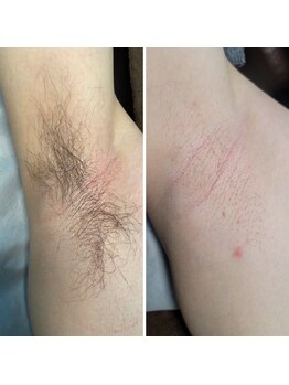 ラフ(LaFF)/脇脱毛Before&After