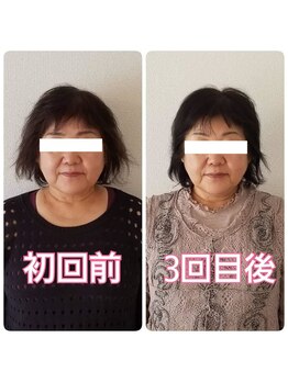 小顔矯正サロン ブルーム/施術3回の変化
