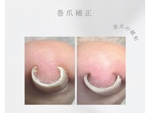 エレアネイル(elea.nail)の雰囲気(フットの巻き爪補正も行っております。)