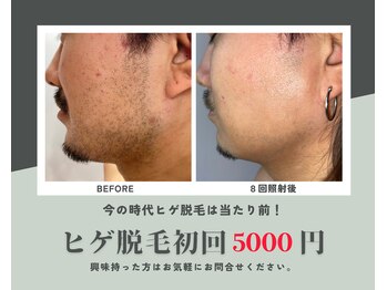 男のカラダビューティー/髭脱毛/髭デザイン