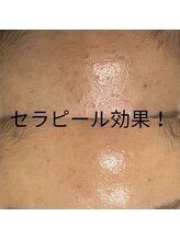 ポリー(Polly)/セラピール効果！/before&after