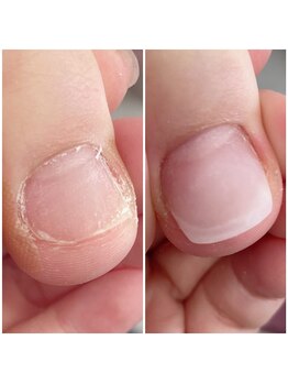 巻き爪ケア