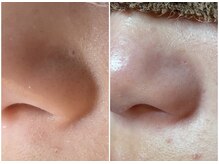 毛穴の悩み解決！なにをしても良くならなかった毛穴お任せ下さい