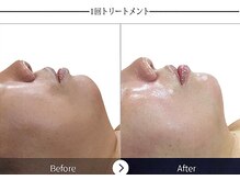 ルナビューティー 赤坂(LUNA beauty)/リジュラン筋膜セラピー