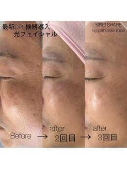 キレイシェア バイ プリンセスローズ静岡駅店(KIREI SHARE)/光フェイシャル
