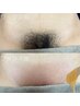 2週間ツルツルが持続◎剃った後のチクチクなし! VIO wax脱毛 ¥5,500