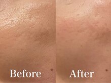 モリタ鍼灸整骨院/美肌リフトフェイシャル