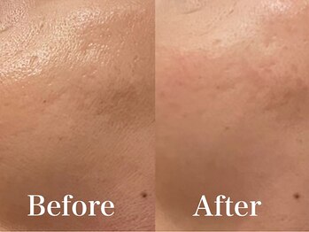 モリタ鍼灸整骨院/美肌リフトフェイシャル