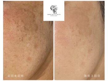 チエミ(Chi e mi)/シミ・くすみ改善★美白ケア