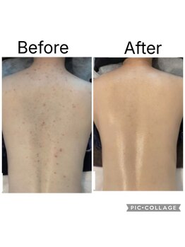 ルリール(Le Rire)/背中ニキビやお肌質改善も◎