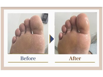 巻き爪補正店 錦糸町店/【タコ・魚の目ケア】