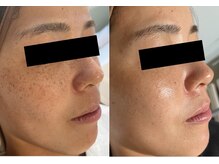 セメ(S'aimer)の雰囲気（シミ、くすみ、肌の色ムラ改善の月1ケア）