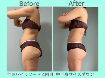 ビーナイス ビューティー(Be Nice Beauty)/ボコボコセル脂肪→☆変化☆