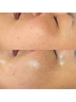 クウラ 学園前店(KUULa)/トラブル肌からモチモチ肌へ