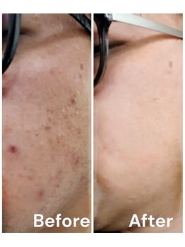 ブライトプラス(BRIGHT+)/肌質改善