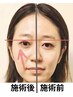 【左右差改善】目/頬/巻き肩の左右差矯正＋エラ/フェイスライン/頭蓋骨縮小