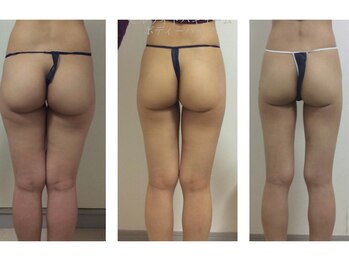 Hb 与野/バキュームによる脚引き締め