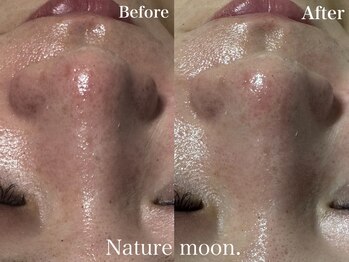 ナチュールムーン(Nature moon.)/毛穴洗浄