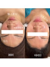 サロン リティナ(Salon Ritina)/ハーブピーリング6回