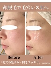 ウィッシュ 与野(Wish)/毛穴改善 顔脱毛