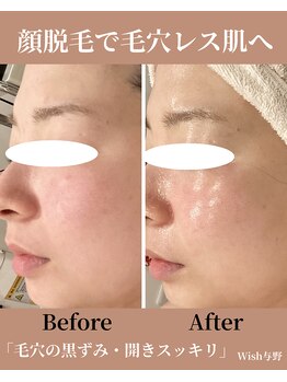ウィッシュ 与野(Wish)/毛穴改善 顔脱毛