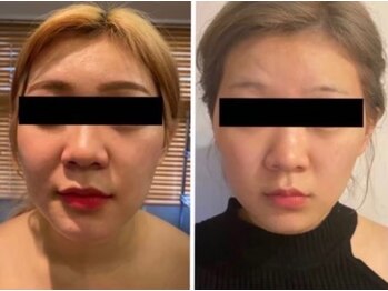 ルナグランデ(Luna grande.)/フェイスラインに注目!